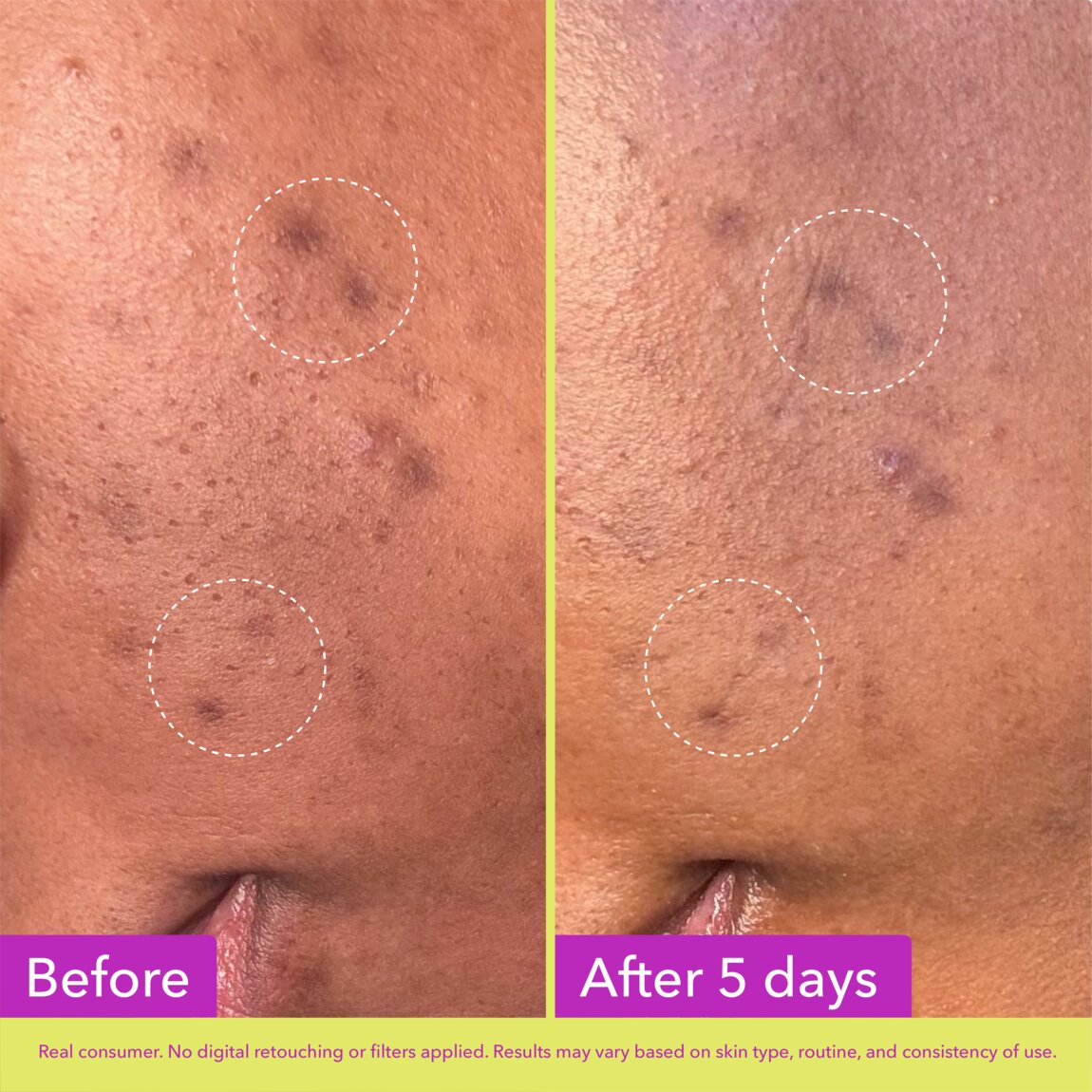 dark-spot-microdart-patches-y0 zb_p.jpg