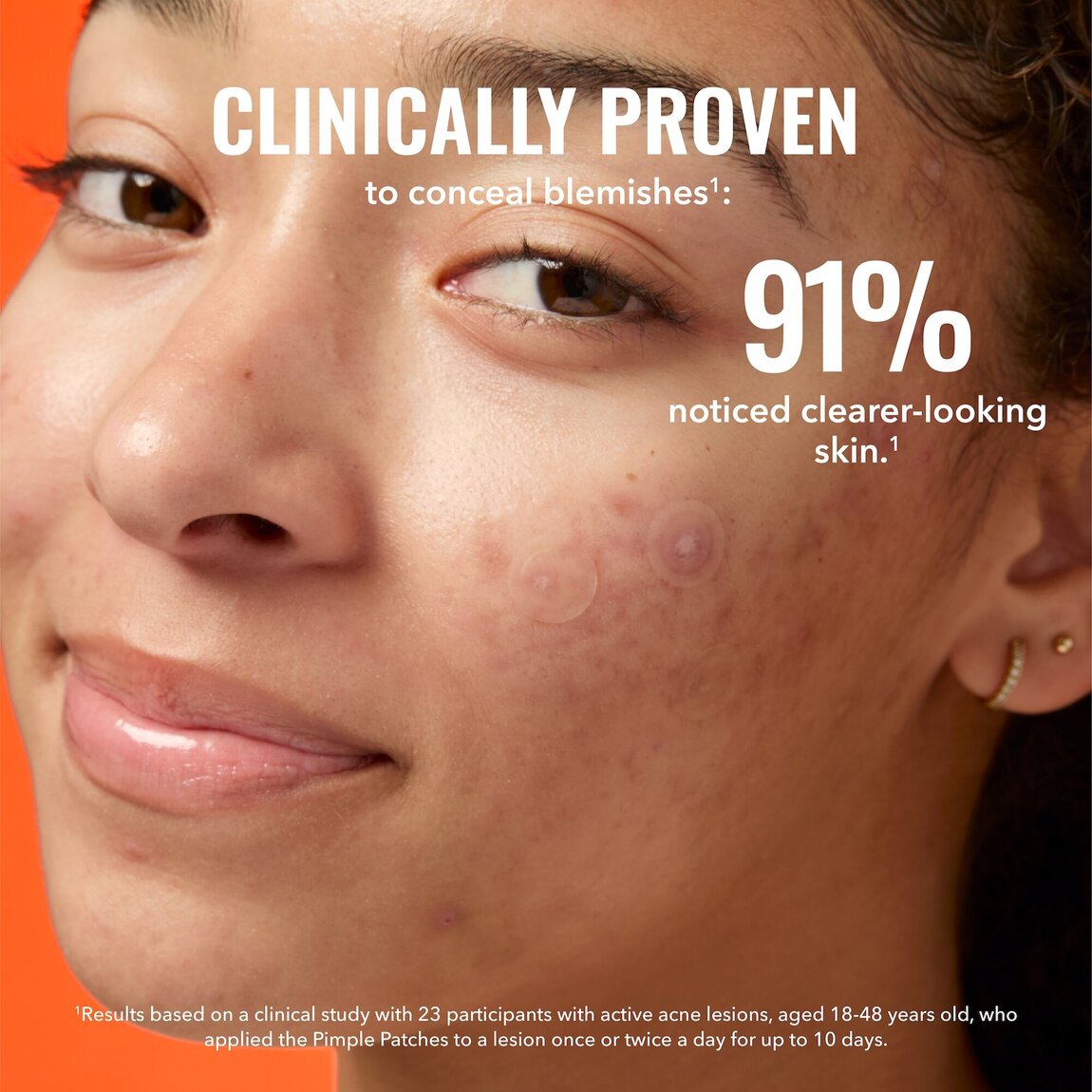 pimple-patches-u2 zb_p.jpg